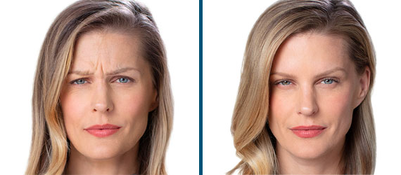 before and after botox in napa valley, ca