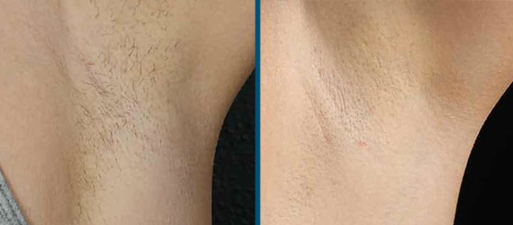before and after laser hair removal in napa