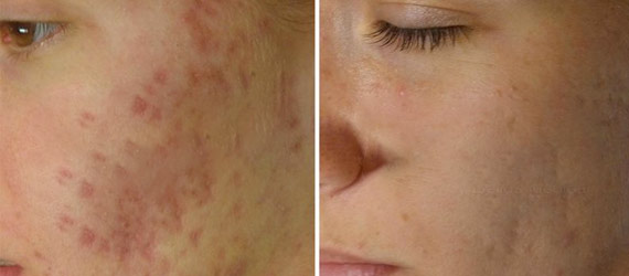 before and after microneedling in napa